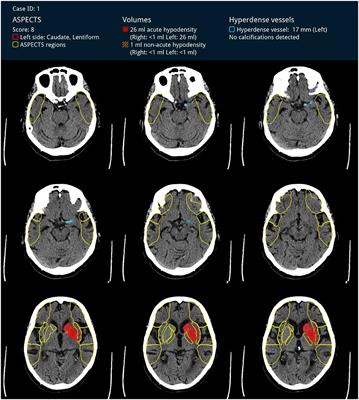 Hyperdense Artery Sign in Patients With Acute Ischemic Stroke–Automated Detection With Artificial Intelligence-Driven Software